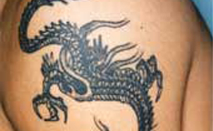 タトゥー（刺青）除去の症例3 before
