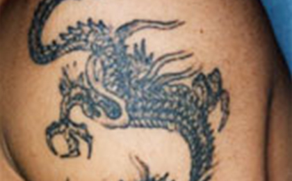 タトゥー（刺青）除去の症例3 after