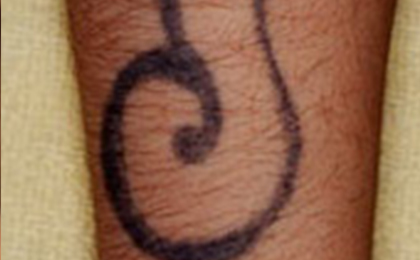 タトゥー（刺青）除去の症例5 before