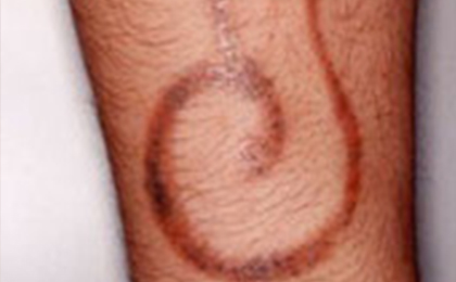 タトゥー（刺青）除去の症例5 after