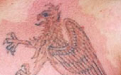 タトゥー（刺青）除去の症例4 after